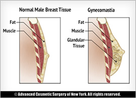 Glandular tissue vs normal male breast tissue