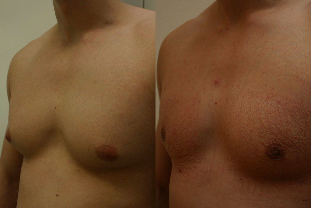 Gynecomastia before after